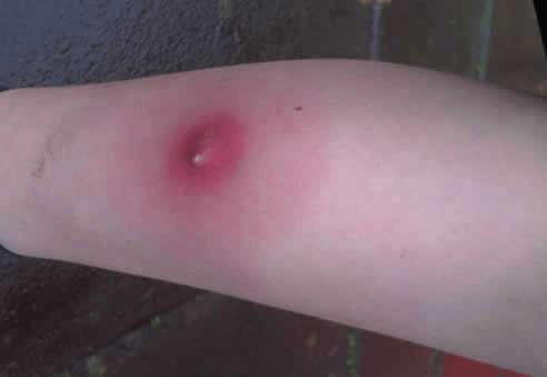 Insect Bites first aid